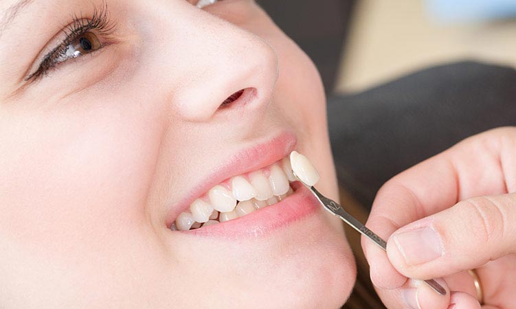 image of dental veneers